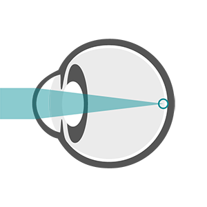 Diagram of the eye showing normal vision